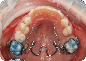 expander