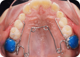 quad helix